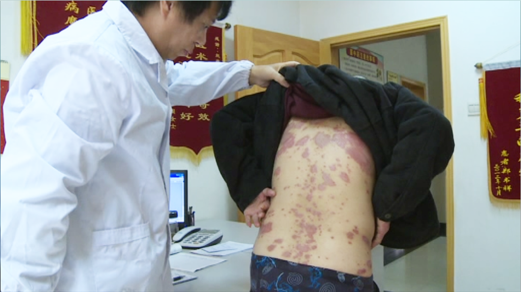 这个方子可让皮癣从此秋冬不犯 非物质文化遗产——赵氏“化癣疗法”令皮癣患者拍手叫绝 - 宜昌春华牛皮癣中医专科医院